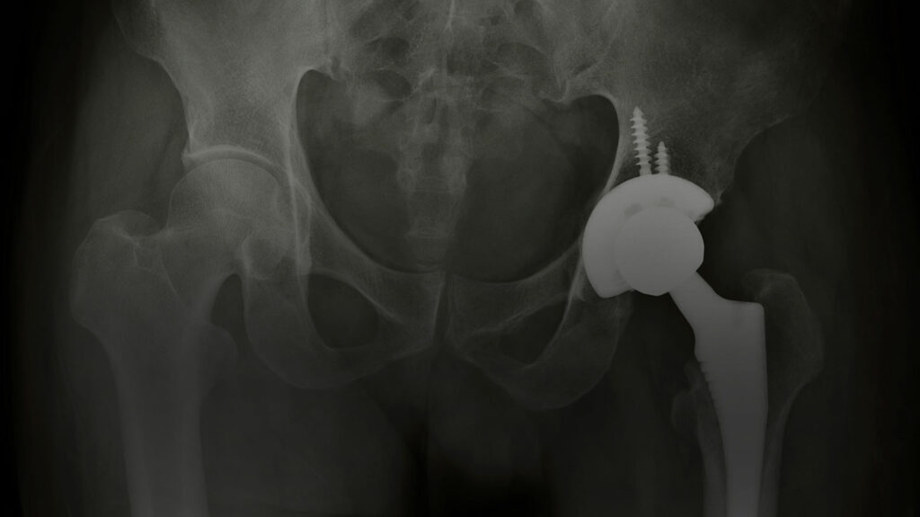 Defective Hip Implant